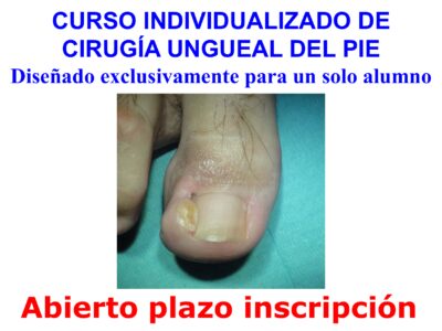 CURSO PRÁCTICO INDIVIDUALIZADO/ASESORÍA DE CIRUGÍA UNGUEAL DEL PIE