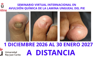 SEMINARIO VIRTUAL INTERNACIONAL EN AVULSIÓN QUÍMICA DE LA LÁMINA UNGUEAL DEL PIE